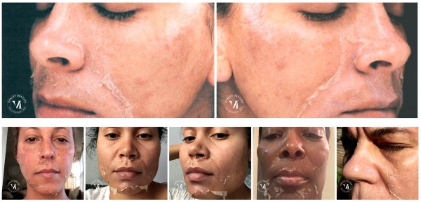 vi peel chemical peel