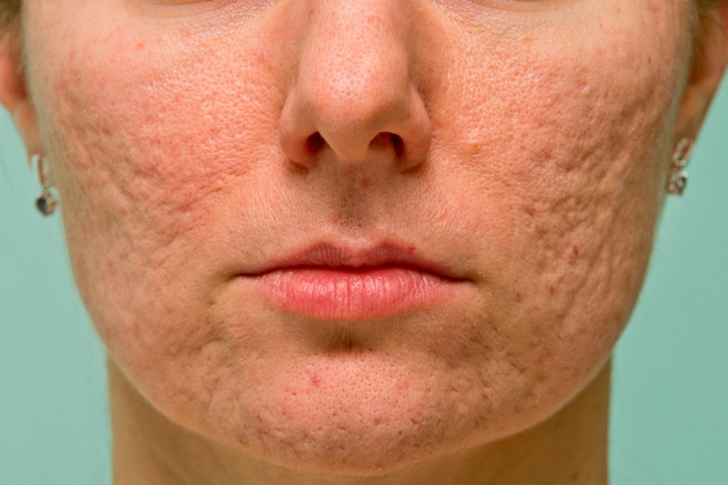 acne scars