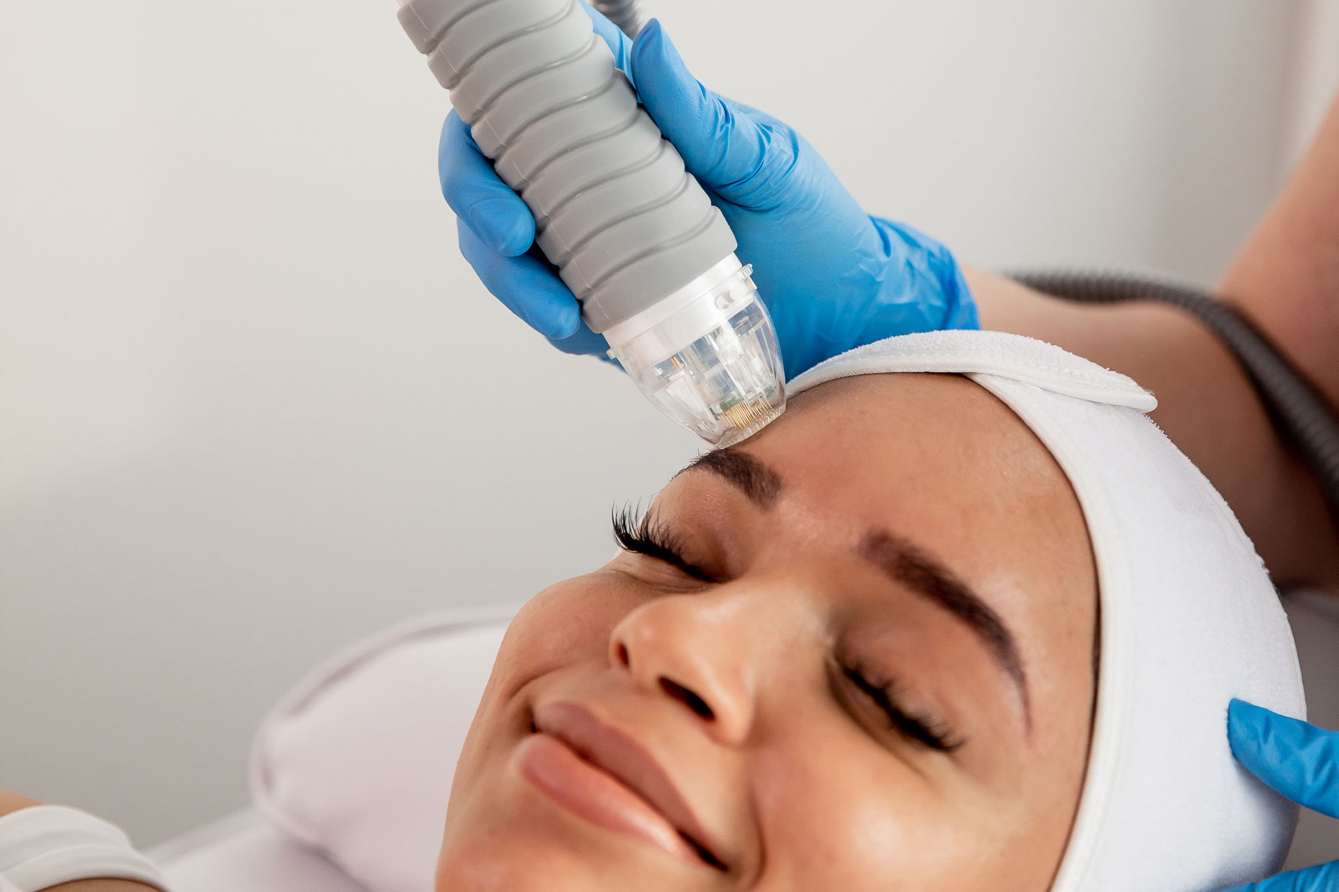 RF Microneedling