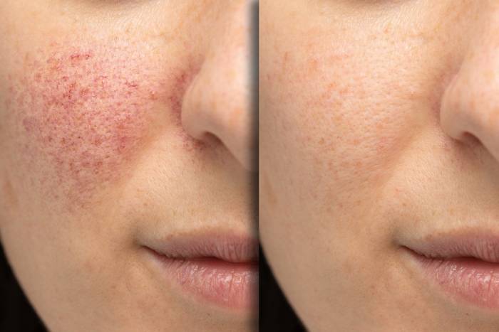 microneedling